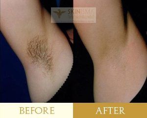 Laser-hair-removal