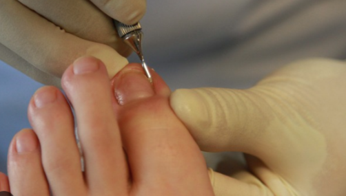 Nail Avulsion Surgery