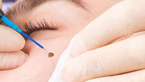 RF Cauterization