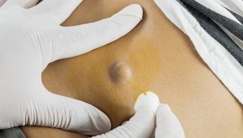 Sebaceous cyst Excision