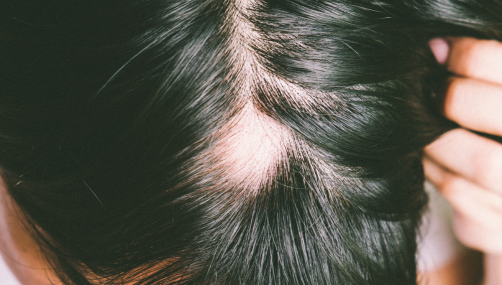 Hair Fall Treatment