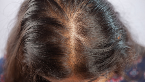 Hair Fall Treatment