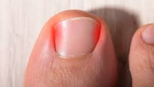 Nail Avulsion Surgery