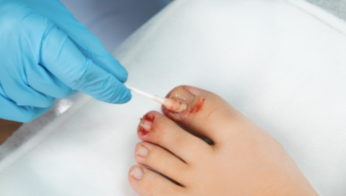 Nail Avulsion Surgery