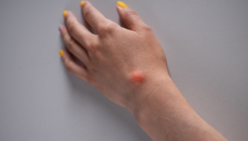Sebaceous cyst Excision