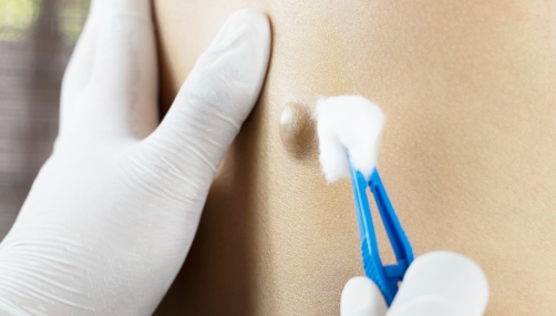 Sebaceous cyst Excision
