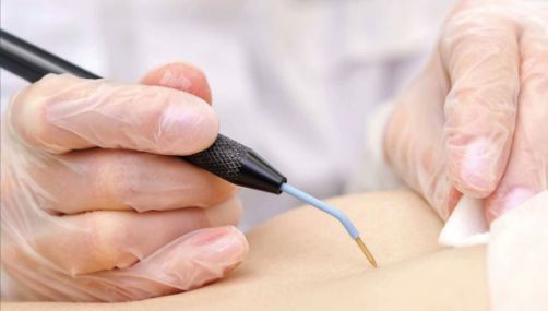 RF Cauterization